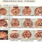 alzheimer