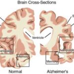 alzheimer