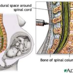 anestesia_peridurale