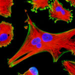 cellule_glioma
