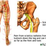 sciatica