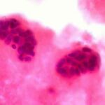breast-cancer