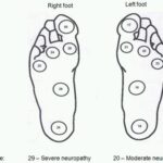 diabetic-foot-screening