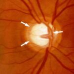 glaucoma