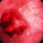Bladder_tumor