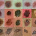 melanoma