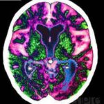 alzheimer