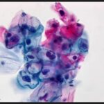 cellule_infettate_HPV