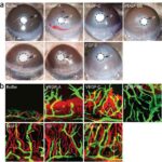 cornea_vessels