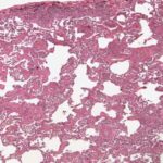 fibrosi