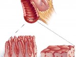 celiachia