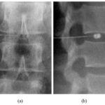 disc_injection