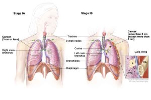 lung_cancer lung cancer 300x199 Cancro del polmone: si inizia a dare identità alle mutazioni cellulari che ne causano lincidenza