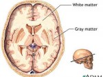 parkinson