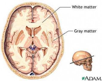 parkinson