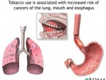 tobacco-and-cancer