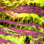 duchenne