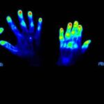 rheumatoid-arthritis