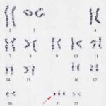 trisomia