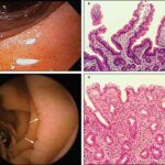 celiachia