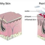 psoriasi