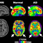alzheimer