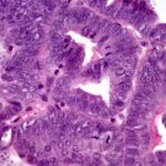 cancro_endometrio