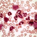 leucemia