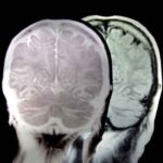 stress_epilessia