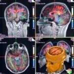 alzheimer_MRI