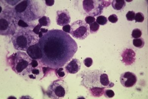 cellule cancerose 300x201 Cellule cancerose affamate di glicina: nuovo indizio per nuove terapie?