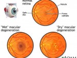 degenerazione_maculare