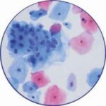 pap_test