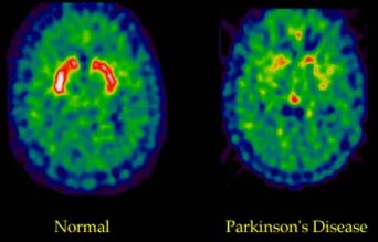 parkinson