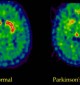 parkinson