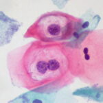 HPV