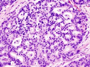 adenocarcinoma 300x225 Boom di tumori aggressivi tra i fumatori di bionde light: per gli oncologi è emergenza