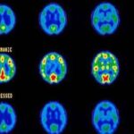 bipolar_disorder