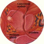 prostata_nosdulo