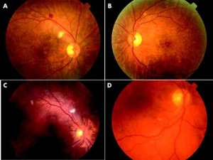 retinopatia 300x225 Retinopatia: un antiossidante riduce il rischio di cecità tra i nati prematuri