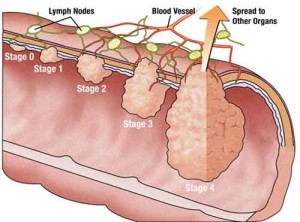 ColorectalCancerStages 300x222 Cancro colon retto: diagnosi precoci ma terapie  intelligenti