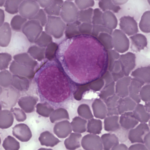 Leukemia_cells