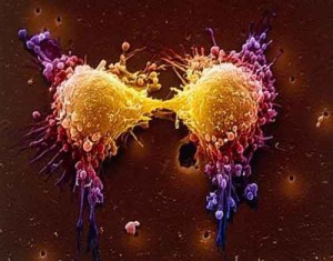 Prostate Cancer cell 300x235 Fumo e cancro della prostata: connessione molto forte, diagnosi sempre più frequenti