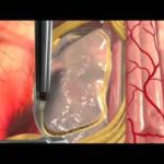 brain_surgery