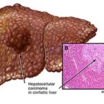 cancro_fegato