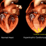 cardiopatie_silenti