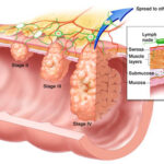 colorectal