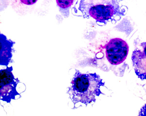 melanoma sistema immunitario 300x237 Melanoma: scoperto meccanismo che inganna e disarma il sistema immunitario