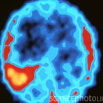 Coloured scintigram of metastatic brain tumour