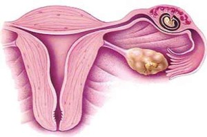 sarcina extrauterina 300x198 Gravidanza extrauterina: primo indiziato il fumo
